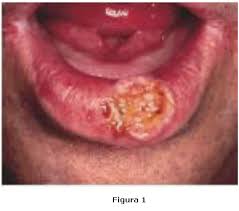 Resultado de imagen para cancer de labios