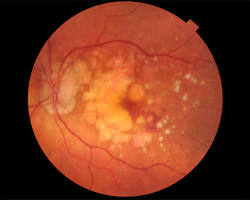 age related macular degeneration retina photo nhs, AI generated
