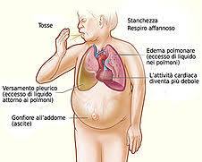 Immagine di Insufficienza cardiaca