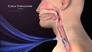 Image result for tracheostomy definition