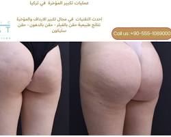 Image of نتائج فيلر المؤخرة قبل وبعد الرياض