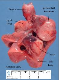 Image result for teratoma