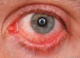 Résultat de recherche d'images pour "eye infection"