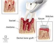 Tooth extraction