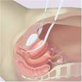 Inkontinenz: Neue Operationsmethode -