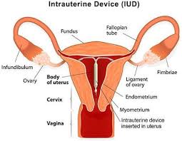 Image result for IUD image
