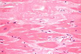 Picture of Cardiac amyloidosis