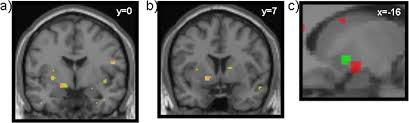 Image result for ventral striatum