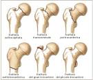 Frattura del femore - Humanitas