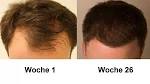 Glatzen vorbeugen Was gegen Haarausfall wirklich hilft