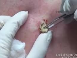 Znalezione obrazy dla zapytania Cysta