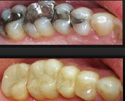 Image result for ‫ترمیم کامپوزیت دندان‬‎