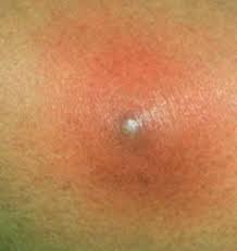 Image result for carbuncle