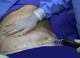 Image result for ‫لیپوساکشن‬‎