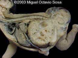 Image result for teratoma