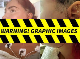 Farrah Abraham's Scary Stitching Revealed After Major Jaw Surgery
