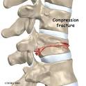 Fractures of the Thoracic and Lumbar Spine-OrthoInfo - AAOS