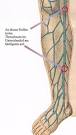 Verschiedene Wadenschmerzen - verschiedene Ursachen