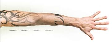 Image result for tattoo removal with laser