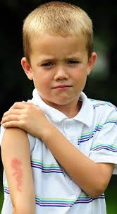 Branded: Joseph Backhouse may be scarred for life after getting a henna tattoo while on holiday in Spain. A seven -year-old boy may be scarred for life ... - article-1306308-0AEC4516000005DC-257_233x423