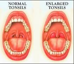 Image result for tonsil stones
