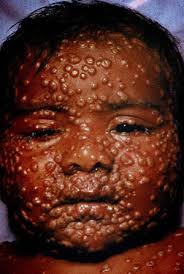 مرض الجدري : Smallpox Images?q=tbn:ANd9GcTy1LxL8Q67FHM4cRD1pMGXmcwqihQO_KXe0HtTYPy9tVhtZC34