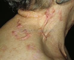 Image result for "Herpes Zoster"