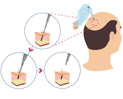DHI hair transplant procedure