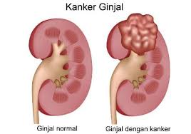 Image result for kanker