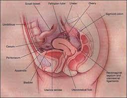 Endometriosis