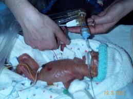 Hasil gambar untuk bayi prematur