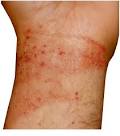 Haut allergie neurodermitis