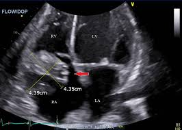 "AngioVac Treatment for Severe Infective Endocarditis in Contraindicated Open Heart Surgery Patient: A Case Study"