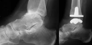 Image result for ankle replacement