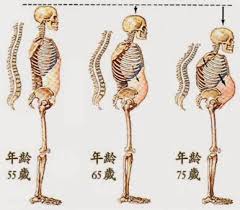 「骨質疏鬆症」的圖片搜尋結果