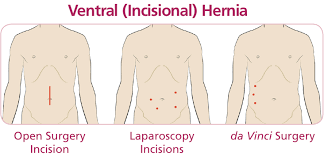 Image result for hernia