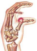 Ruptura Ligamento colateral cubital del pulgar