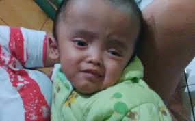 Alif Rizky Ramadhan, bayi berusia 1,5 tahun yang menderita penyakit hydrocephalus sedang dalam pangkuan ibunya di rumah kakeknya di Gg. Banceuy, ... - alif-rizky-ramadhan