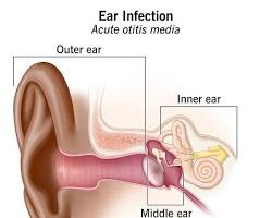 Image of Ear infection (otitis media)