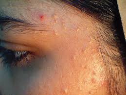 Comedonal acne best treatment