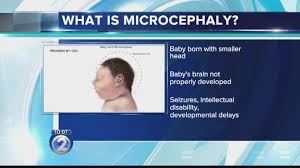 Image result for microcephaly meaning