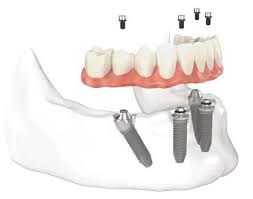 Diagram of a denture with dental implant attachments