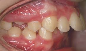Image result for severe protruded teeth