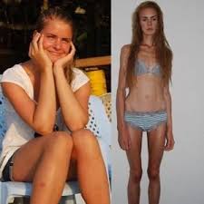 Risultati immagini per anoressica