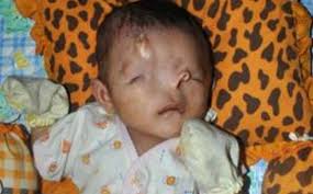 COM, BANJARMASIN- Pemberitaan gencar yang dilakukan Banjarmasin Post Grup terhadap Akhmad Fauzan Azhimi (6 bulan), bayi yang memiliki hidung di atas kening ... - bayi-hidung-di-kening