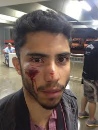 André Borgesfoi atingido no rosto com um tiro de bala de borracha (Crédito: Sergio Lima/ Folhapress). Um protesto em Brasília na última segunda-feira, ... - fot%25C3%25B3grafo-atingido