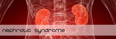 Image result for nephrotic syndrome child