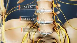 Image result for slipped disc pid