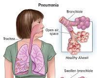 Imagem de Pneumonia