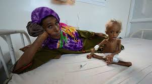 Image result for Shocking images of starved kid show horrors of Yemen’s civil war